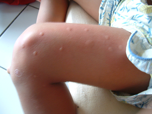mosquito-bites